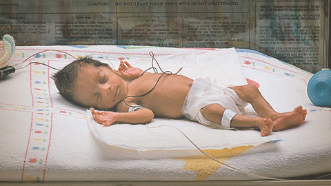 Pregunta y respuesta sobre bebés prematuros
